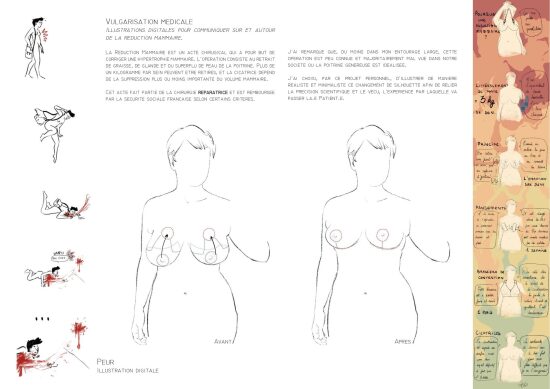 Illustrations médicales - Réduction mammaire